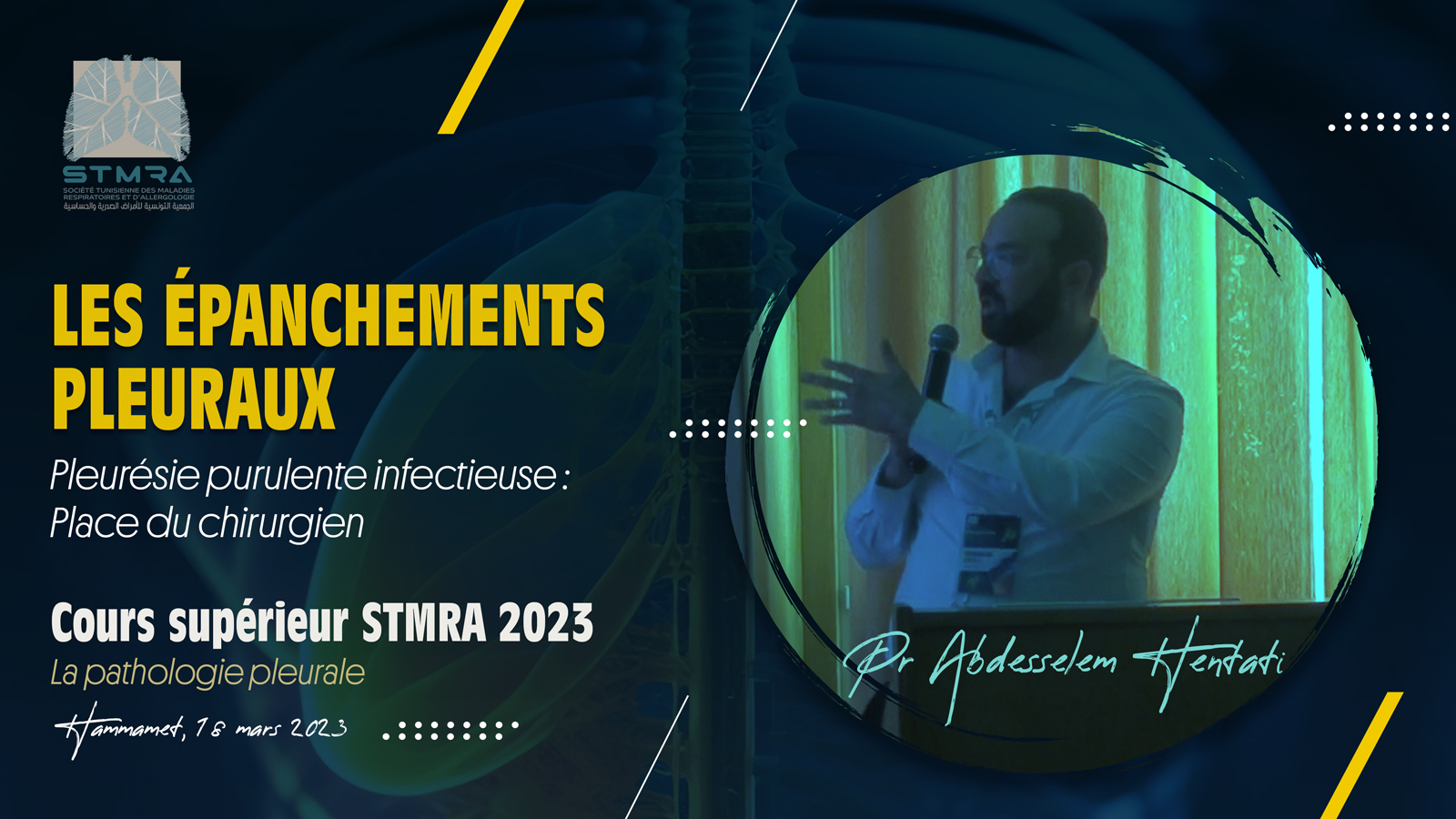 Pleurésie purulente infectieuse : place du chirurgien