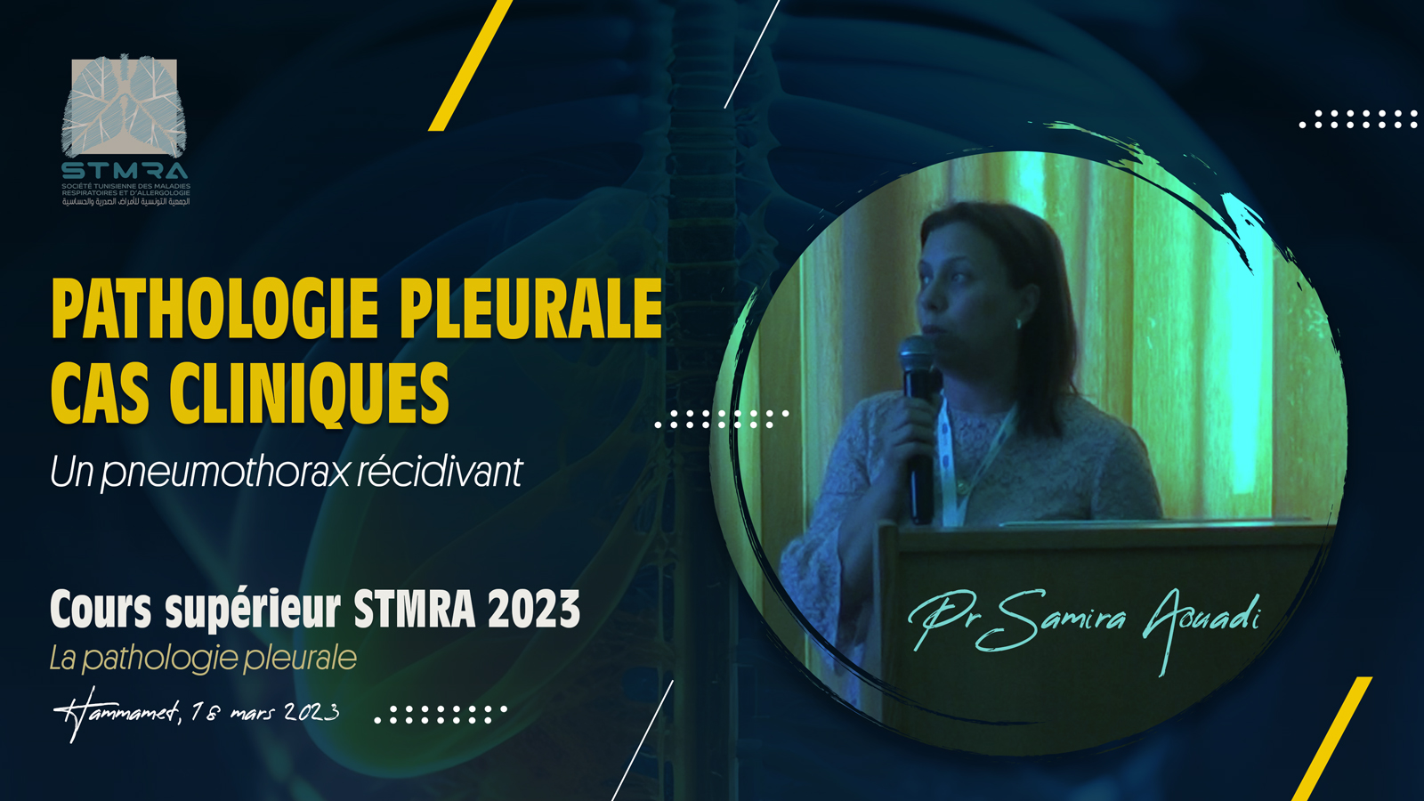 Cas clinique sur la pathologie pleurale : Un pneumothorax récidivant