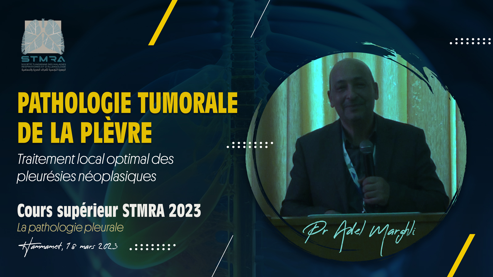 Traitement local optimal des pleurésies néoplasiques